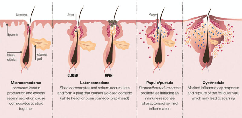Acne | Faciem Dermatology & Medical Clinic