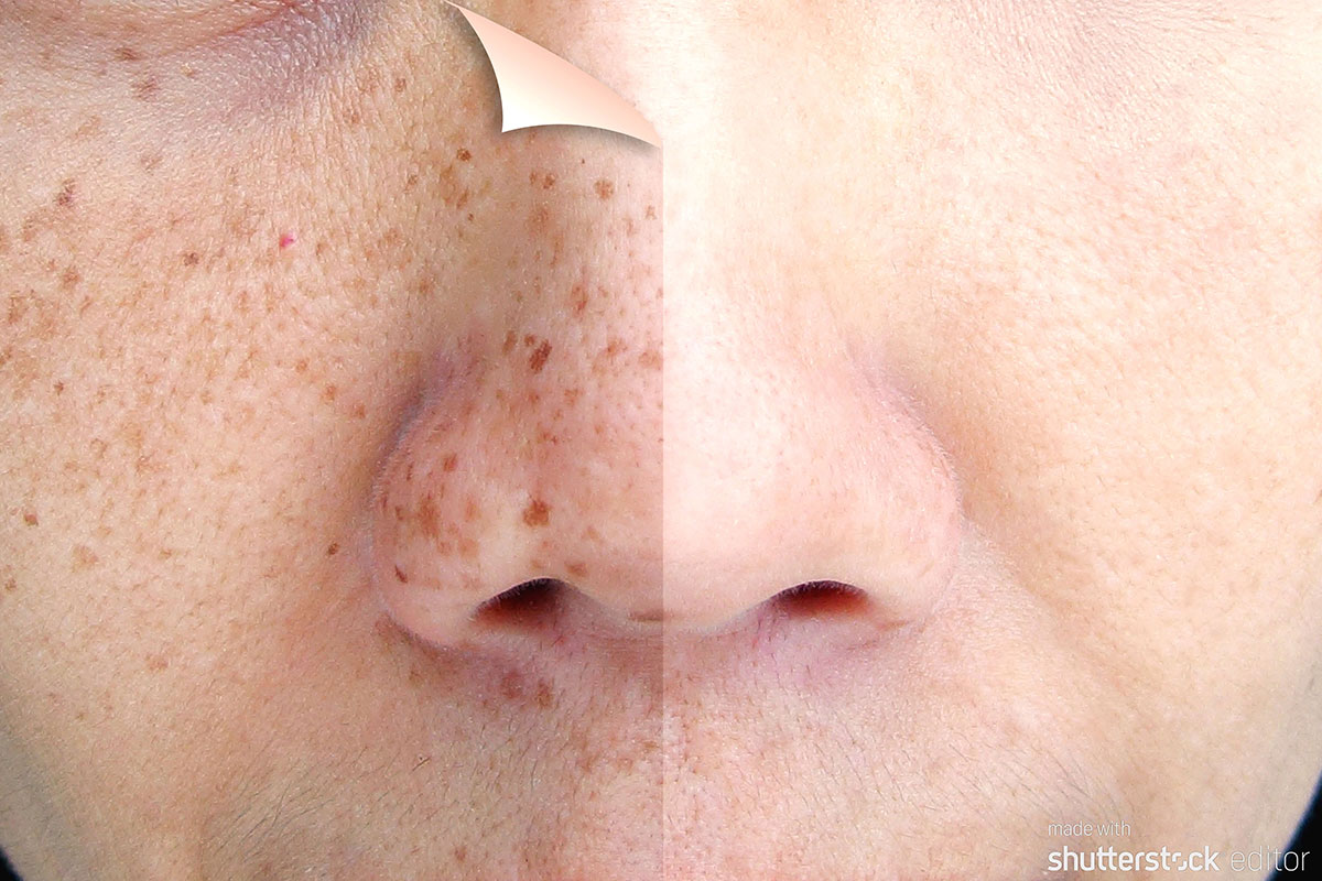 What's The Difference Between Freckles And Sun Spots?: Center