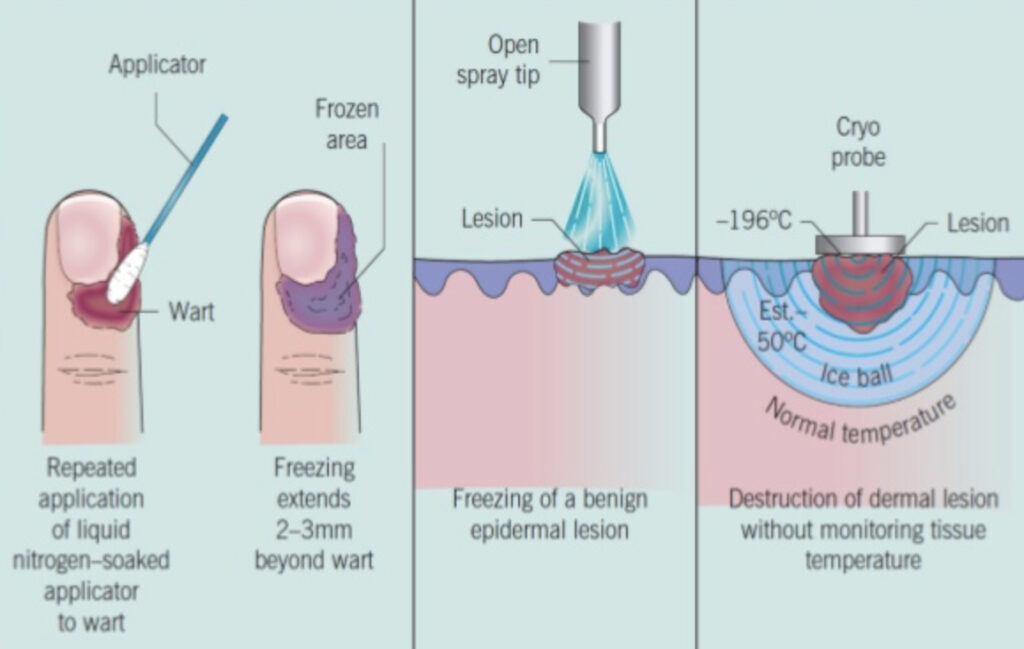 Cryotheraphy | Faciem Dermatology & Medical Clinic