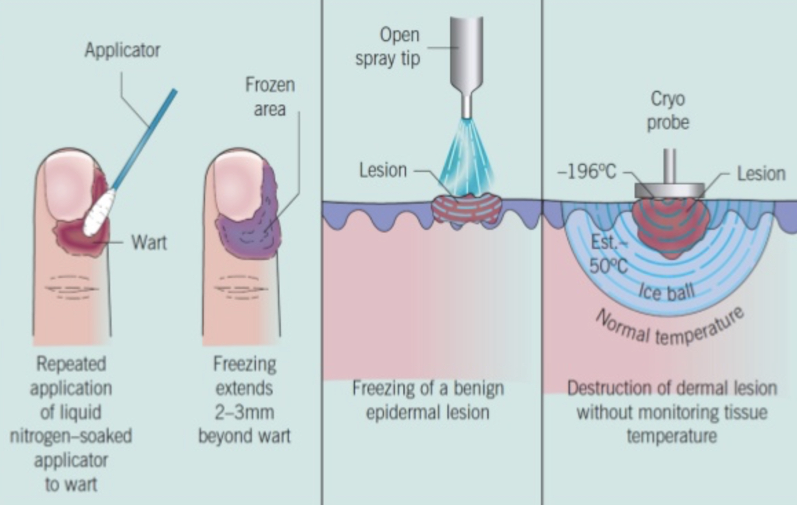 Cryotheraphy