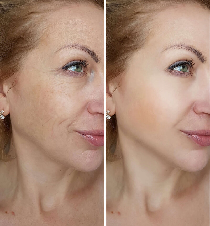 Dermal Fillers London Faciem Dermatology Clinic