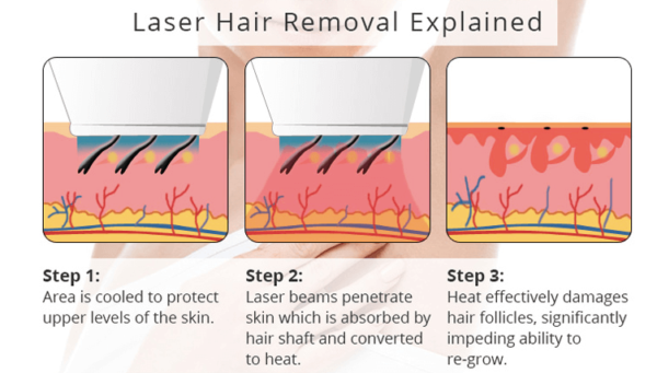 laser hair removal research