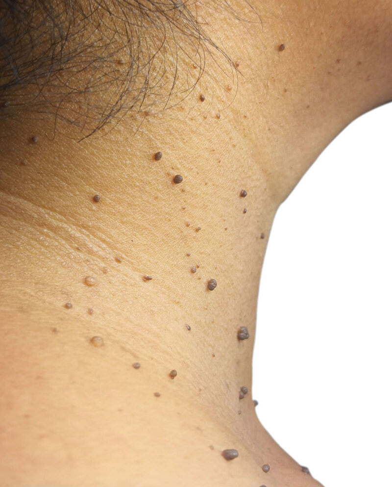 Lumps And Bumps Faciem Dermatology Clinic