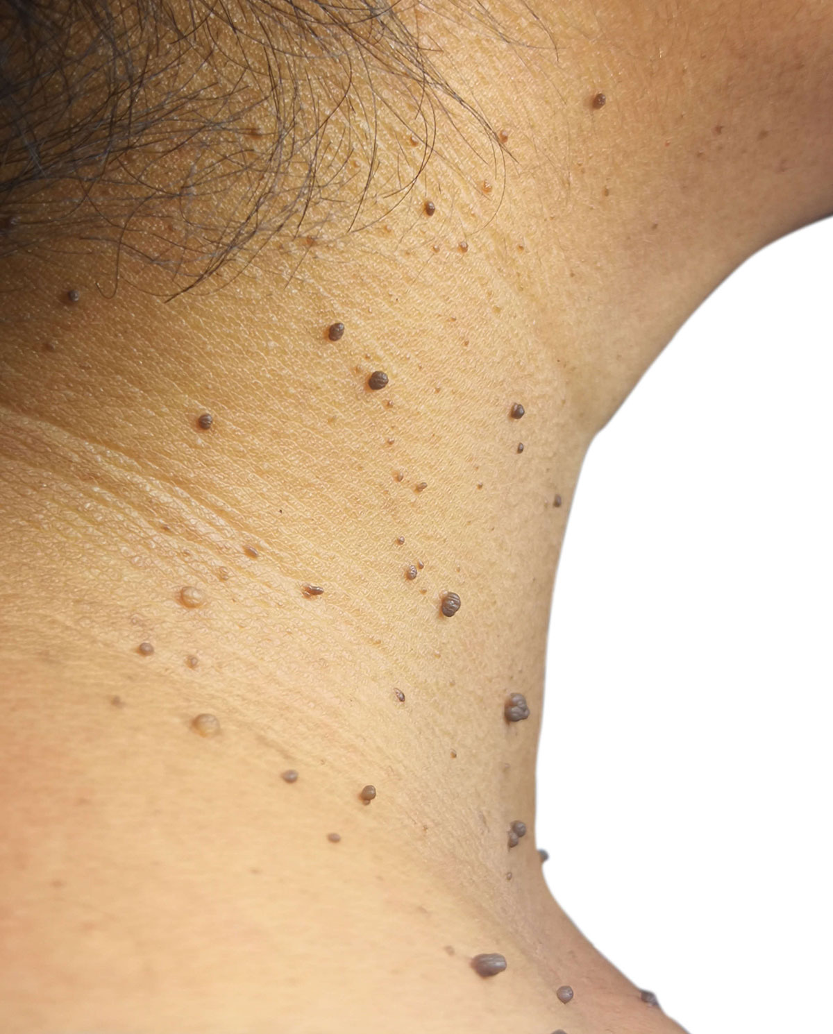and Bumps | Faciem Dermatology Clinic