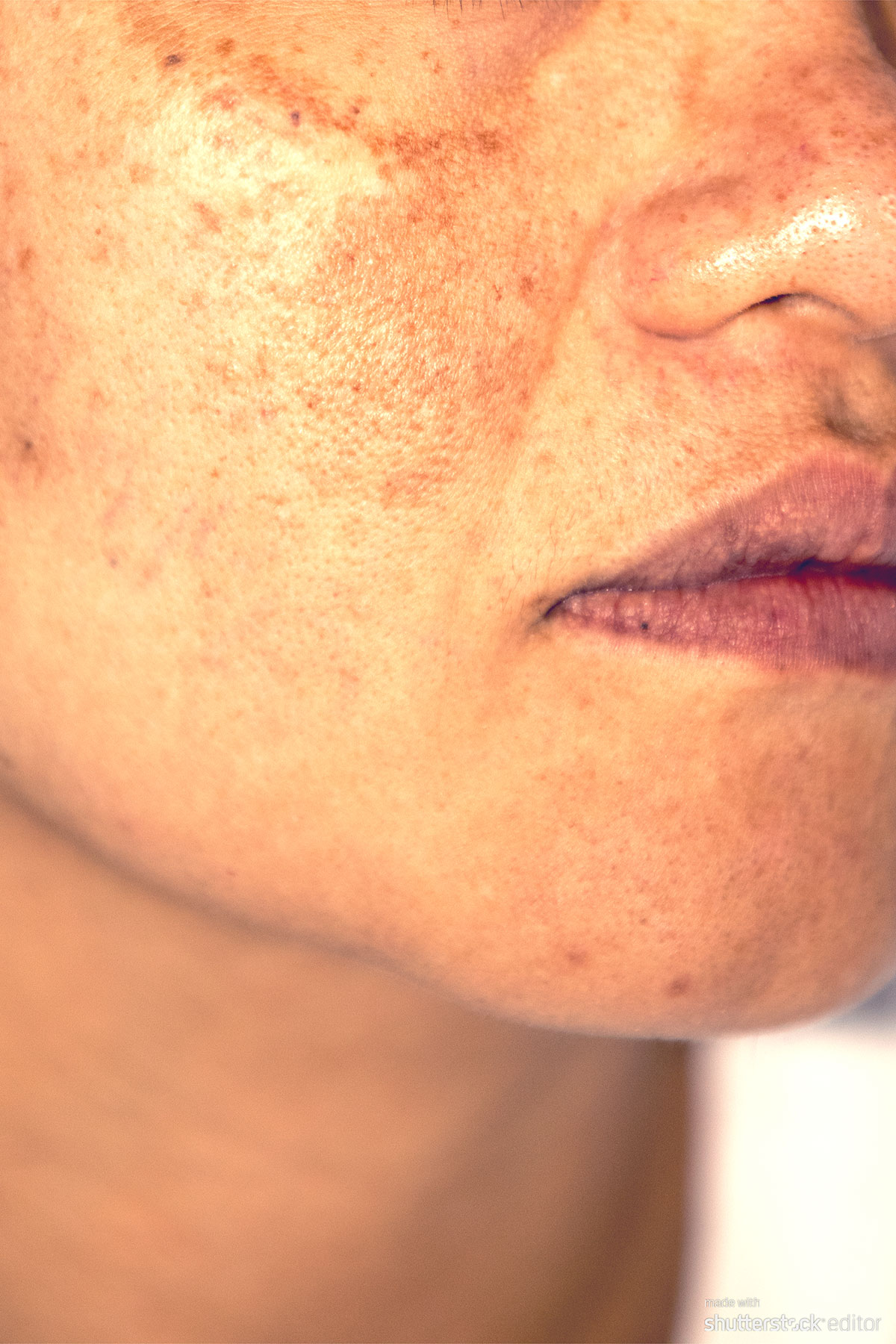 Hyper Pigmentation Faciem Dermatology Clinic