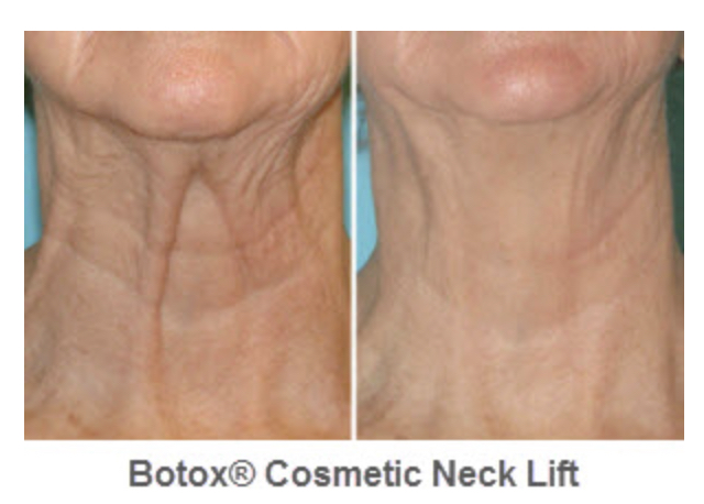Neck/Chest wrinkle and aged skin