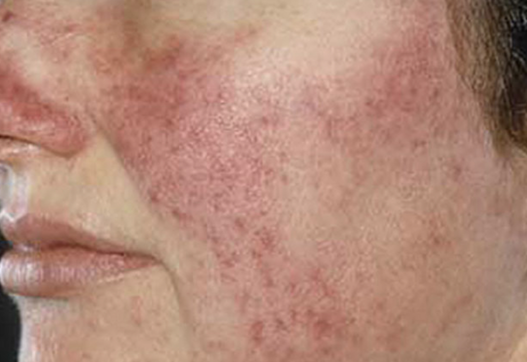 Rosacea Faciem Dermatology Clinic