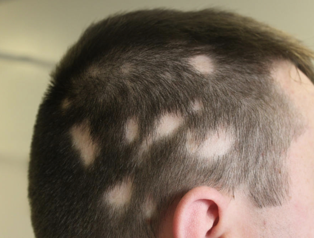 Очаговая алопеция (alopecia Areata)