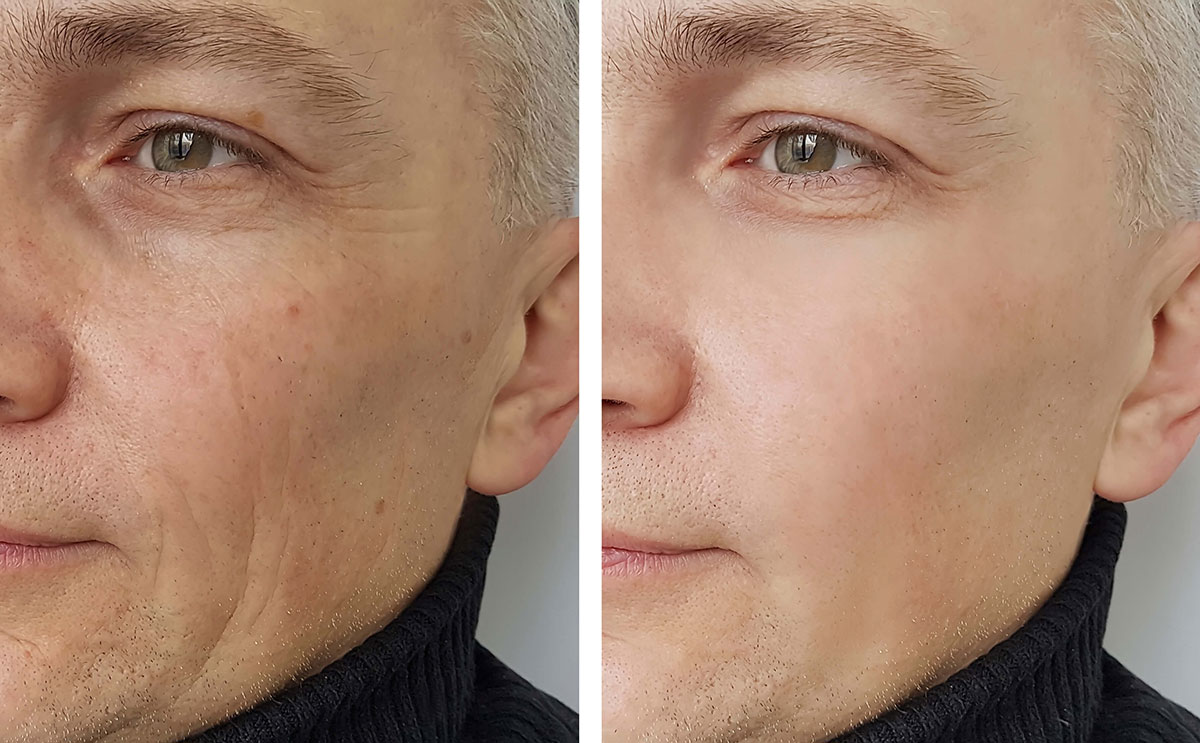 Dermal Fillers London Faciem Dermatology Clinic