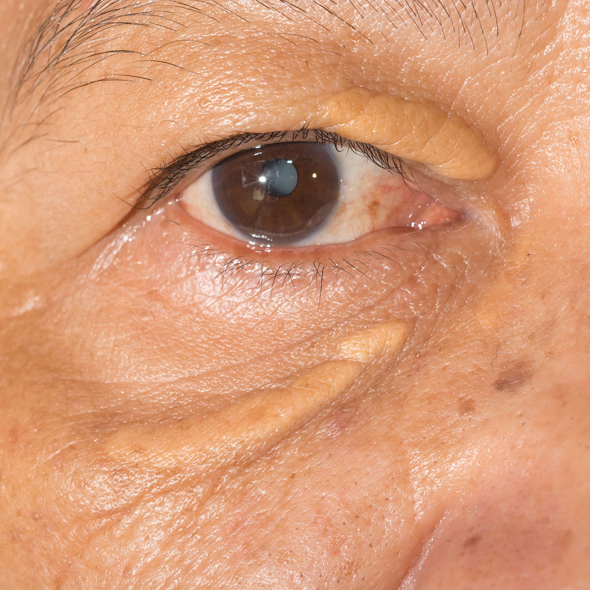 Yellow areas on eyelids