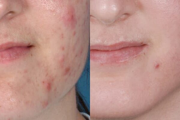 ZO® Skin Health Before & After