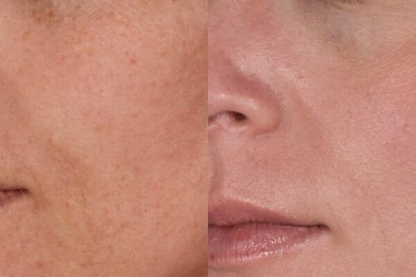 ZO® Skin Health Before & After