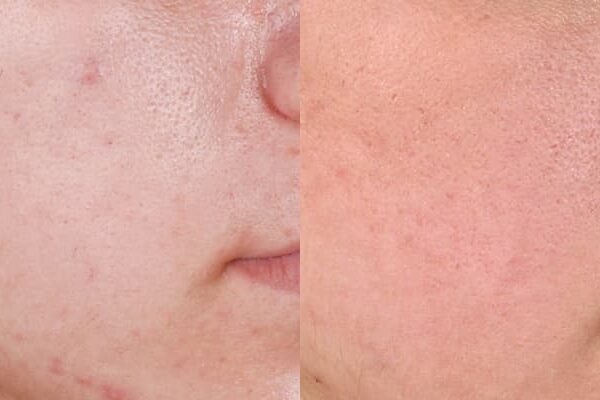 ZO® Skin Health Before & After