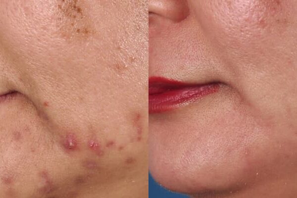 ZO® Skin Health Before & After