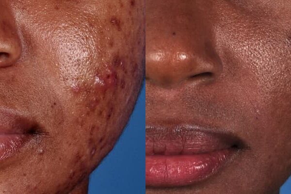 ZO® Skin Health Before & After