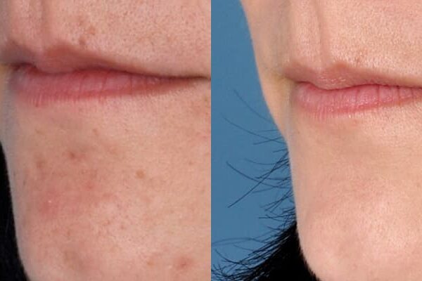 ZO® Skin Health Before & After