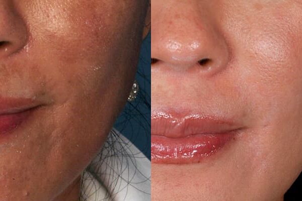 ZO® Skin Health Before & After