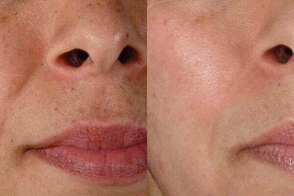 ZO® Skin Health Before & After