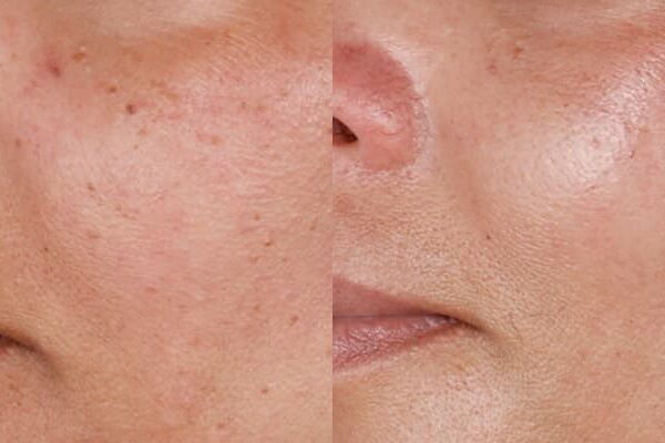 ZO® Skin Health Before & After