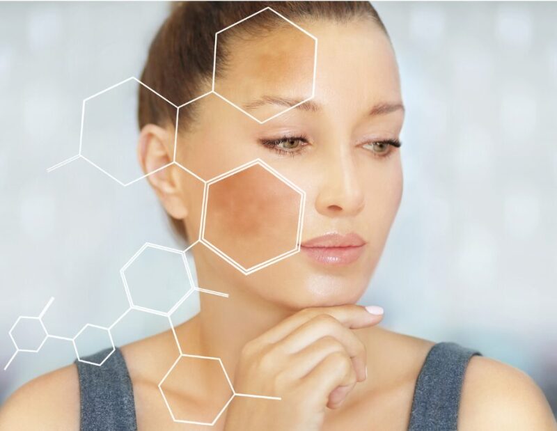 Hyperpigmentation Hyperpigmentation Before and after