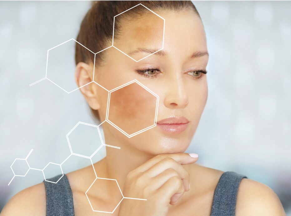 Hyperpigmentation Before and after