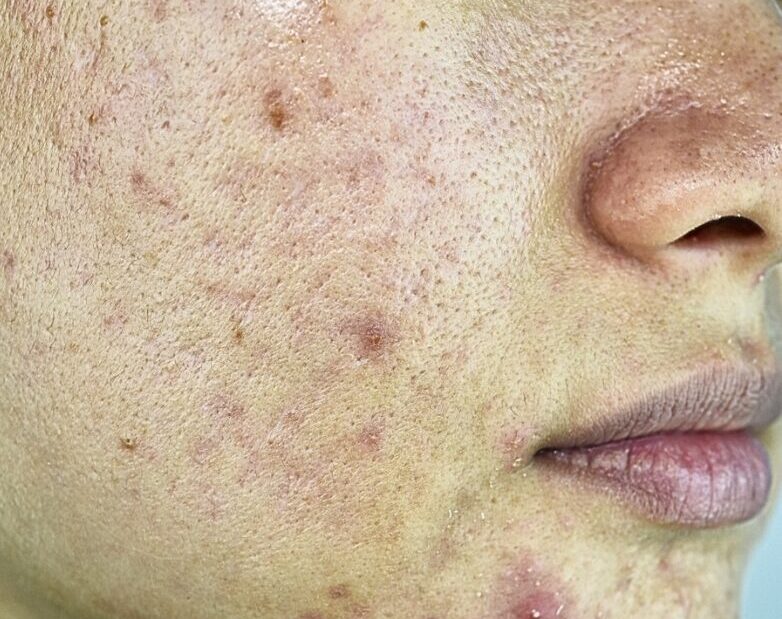 Acne Acne on Face