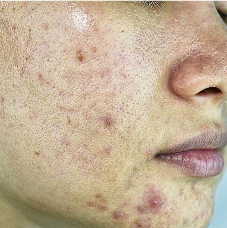 Acne on Face