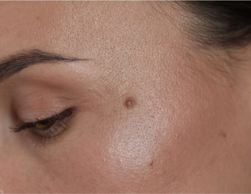 Benign Lesions Targeting Benign Lesions: A Reader’s Guide to Hyfrecation/ Cautery.