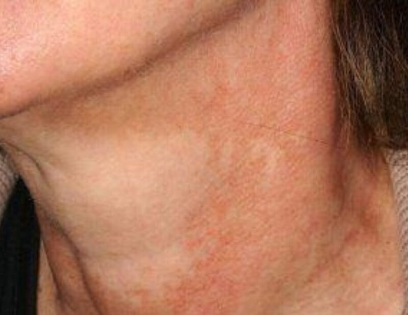 Poikiloderma of Civatte Poikiloderma of Civatte